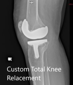 Postoperative X-ray showing the lateral view of the right and the left knee respectively