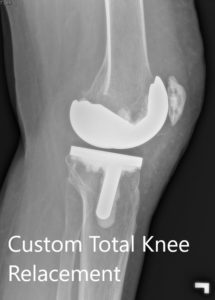 Postoperative X-ray showing the lateral view of the right and the left knee respectively - img 2