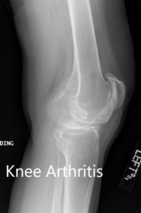 Preoperative X-ray showing the lateral views of the right and the left knee respectively - img 2