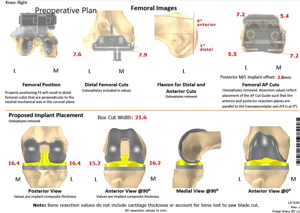 Complete Orthopedics patient specific surgical plan for a Bilateral Custom Total Knee Replacement in a 61-year-old male with Knee Arthritis & Genu Valgum Deformity - scan 4