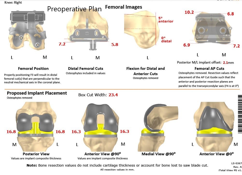 Complete Orthopedics patient specific surgical plan for a Bilateral Customized Total Knee Replacement in a 72-year-old female - scan 4