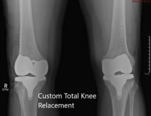 Postoperative X-ray showing the AP view of both knees