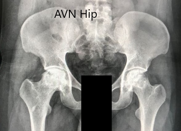 Radiografía preoperatoria de la pelvis con ambas caderas en vista anteroposterior que muestra AVN de ambas caderas