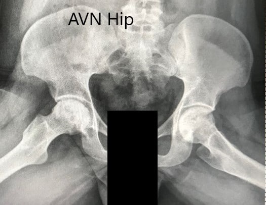 Radiografía preoperatoria de la pelvis con ambas caderas en la vista lateral de patas de rana que muestra AVN de ambas caderas