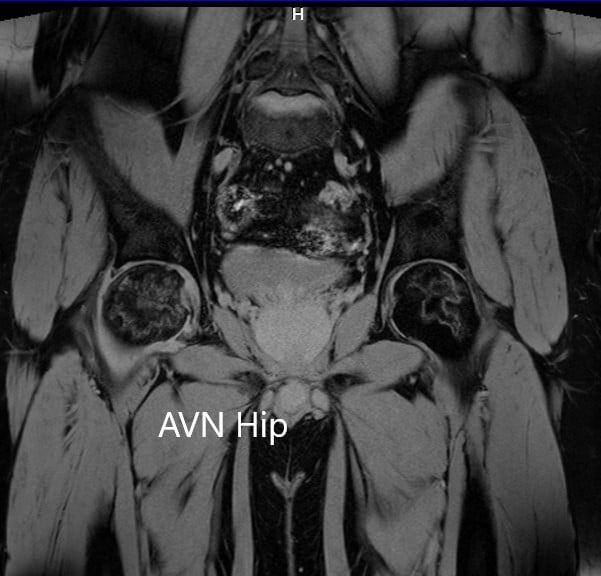 Sección coronal T2WI de resonancia magnética que muestra AVN cadera