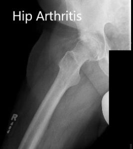 Radiografía preoperatoria que muestra las vistas laterales de la pata de rana de la articulación de la cadera derecha e izquierda