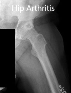 Radiografía preoperatoria que muestra las vistas laterales de la pata de rana de la articulación derecha e izquierda de la cadera - img 2