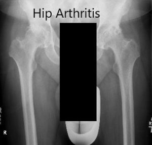 Radiografía preoperatoria que muestra la vista AP de la pelvis con ambas caderas