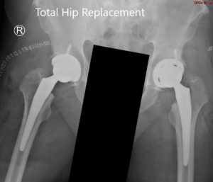 Radiografía postoperatoria que muestra la vista AP de la pelvis con ambas caderas