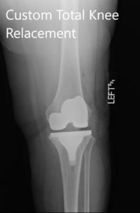 Imágenes radiográficas postoperatorias que muestran la AP y las vistas laterales de la rodilla izquierda