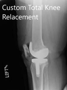 Radiografías posoperatorias que muestran la AP y las vistas laterales de la rodilla izquierda - img 2