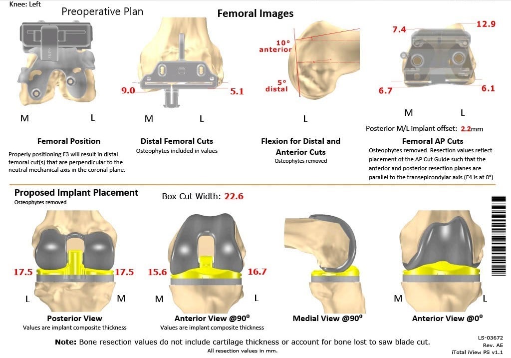 Complete Orthopedics patient specific surgical plan for a Custom Left Knee Total Replacement in a 68-year-old Female - scan 2