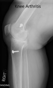 Radiografía preoperatoria que muestra la AP y las vistas laterales de la rodilla derecha con tornillos retenidos consistentes con la reconstrucción del LCA - img 2