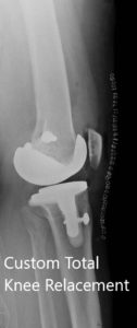 Imágenes postoperatorias que muestran AP y vistas laterales de la rodilla derecha - img 2