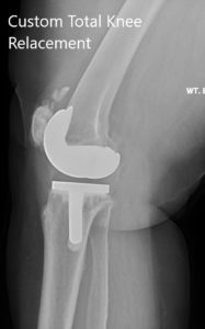 Postoperative X-ray showing the lateral views of both knees - img 2