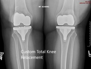 Postoperative X-ray showing the AP view of both knees