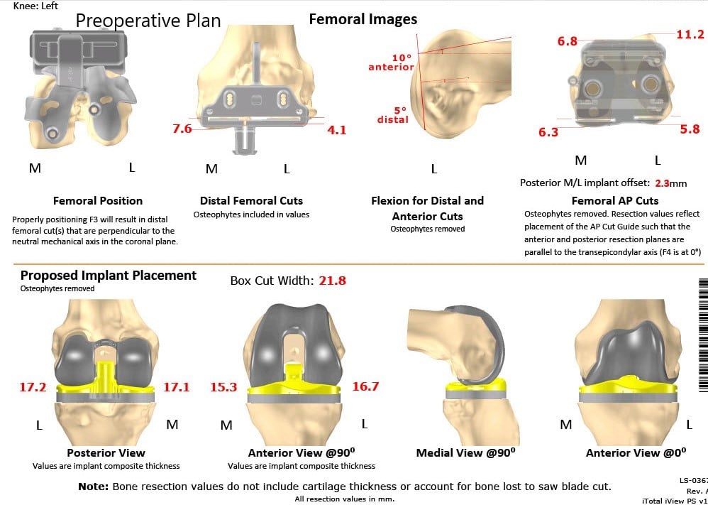 Complete Orthopedics patient specific surgical plan for a Customized Left Knee Total Replacement in a 66-year-old female - scan 2