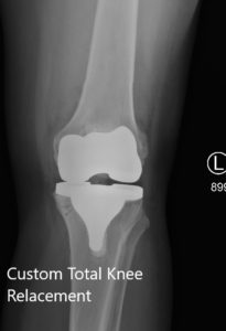 Postoperative X-ray showing the AP and lateral views of the left knee