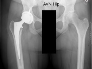 Radiografía preoperatoria de la pelvis con ambas caderas mostrando articulación artificial intacta en el lado derecho y AVN de la cadera izquierda