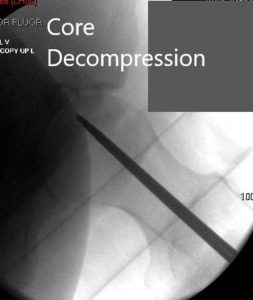 Vista anteroposterior de la cadera izquierda que muestra necrosis avascular precolapso de la cadera izquierda - img 2