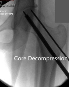 Descompresión del núcleo en el sitio de necrosis avascular