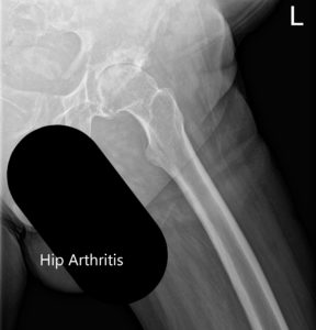 Radiografía preoperatoria que muestra la vista lateral y AP de la cadera izquierda con patas de rana