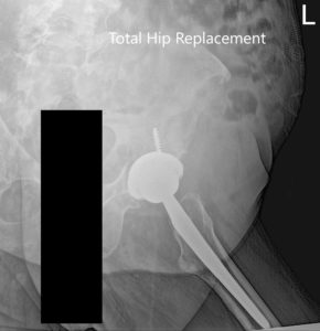 Radiografía postoperatoria de la pelvis y vista lateral de la cadera izquierda - img 2