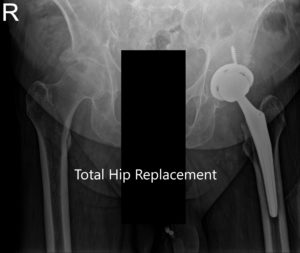 Radiografía postoperatoria de la pelvis y vista lateral de la cadera izquierda