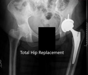 Postoperative X-ray showing the AP view of the pelvis and lateral view of the left hip