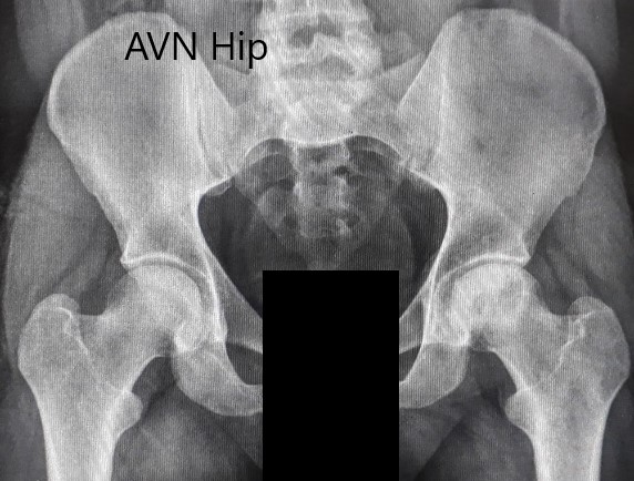 Preoperative X-ray of the pelvis with both hips in anteroposterior view showing AVN of the Left Hip