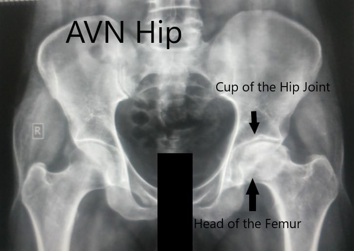 Vista anteroposterior de la pelvis con ambas caderas