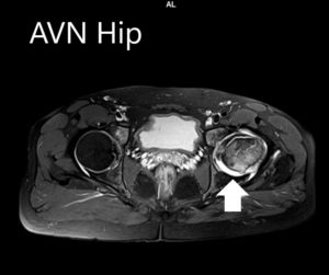 Imágenes de resonancia magnética que muestran necrosis avascular de la cadera izquierda con colapso - exploración 2