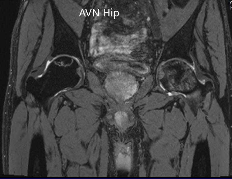 Sección coronal T2WI de resonancia magnética que muestra AVN cadera