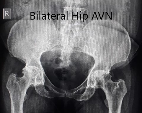 Radiografía preoperatoria de la pelvis en vista anteroposterior