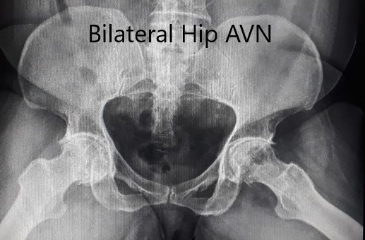 Radiografía preoperatoria de la pelvis en vistas laterales con patas de rana