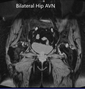 Sección coronal de T1WI de la pelvis Resonancia magnética