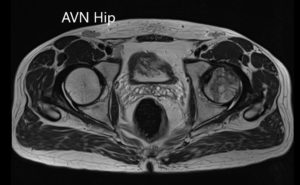 Axial sections of the T1WI