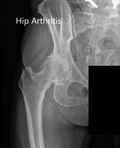 Preoperative X-ray Showing the AP and lateral views of the right hip