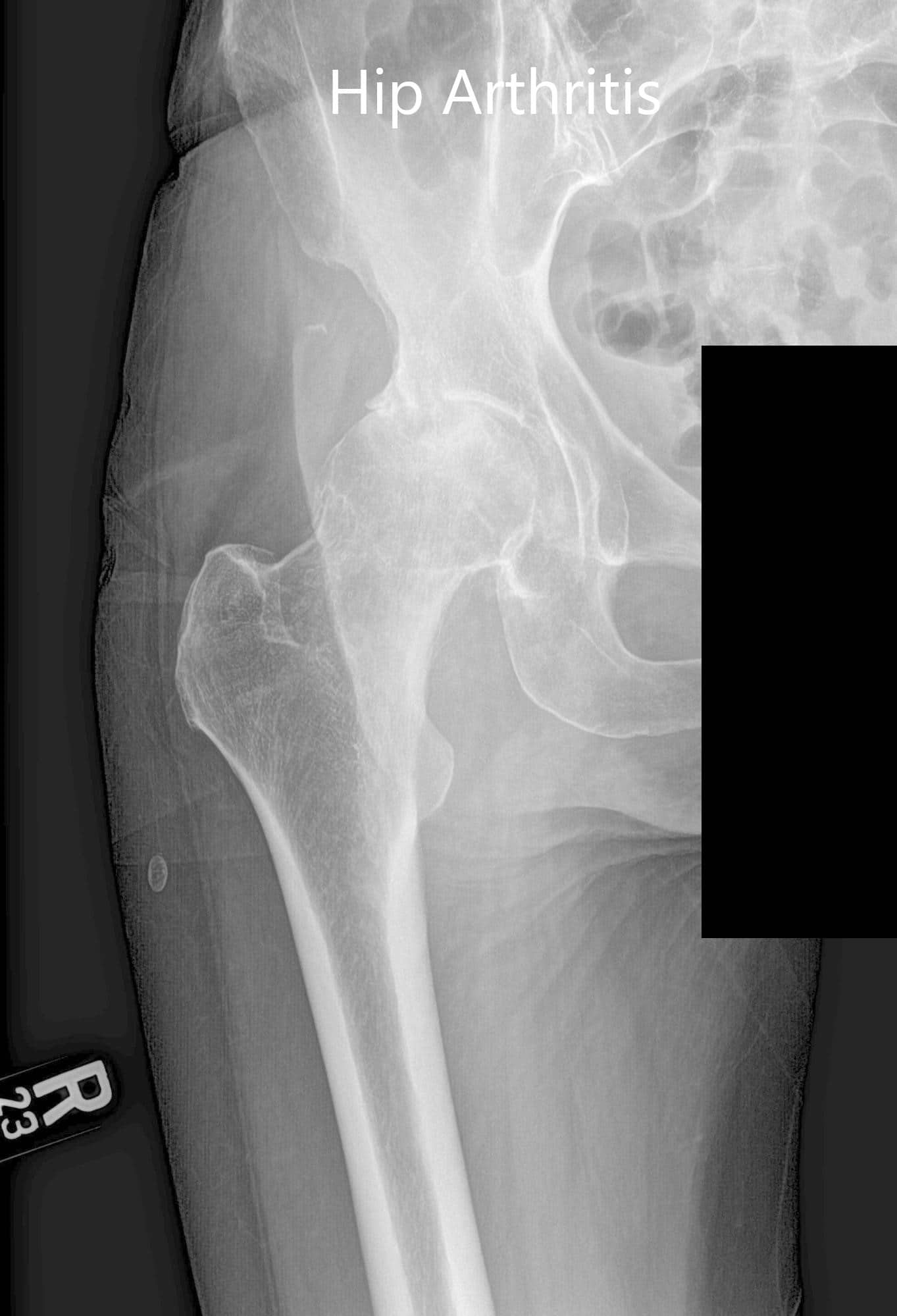 Case Study Bilateral Total Hip Arthritis In Yr Old Male