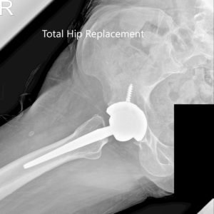 Postoperative X-ray showing the AP and lateral views of the right hip - img 2