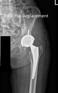 Postoperative X-ray of the left hip showing AP and lateral views