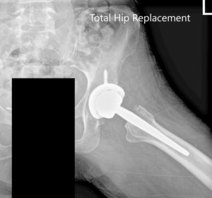 Postoperative X-ray of the left hip showing AP and lateral views - img 2