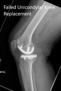 Radiografía preoperatoria de la rodilla derecha en vistas anteroposterior y lateral