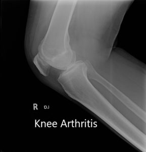 Preoperative X-ray showing AP and lateral view of the right knee joint, and skyline view of both the knee joints - img 2