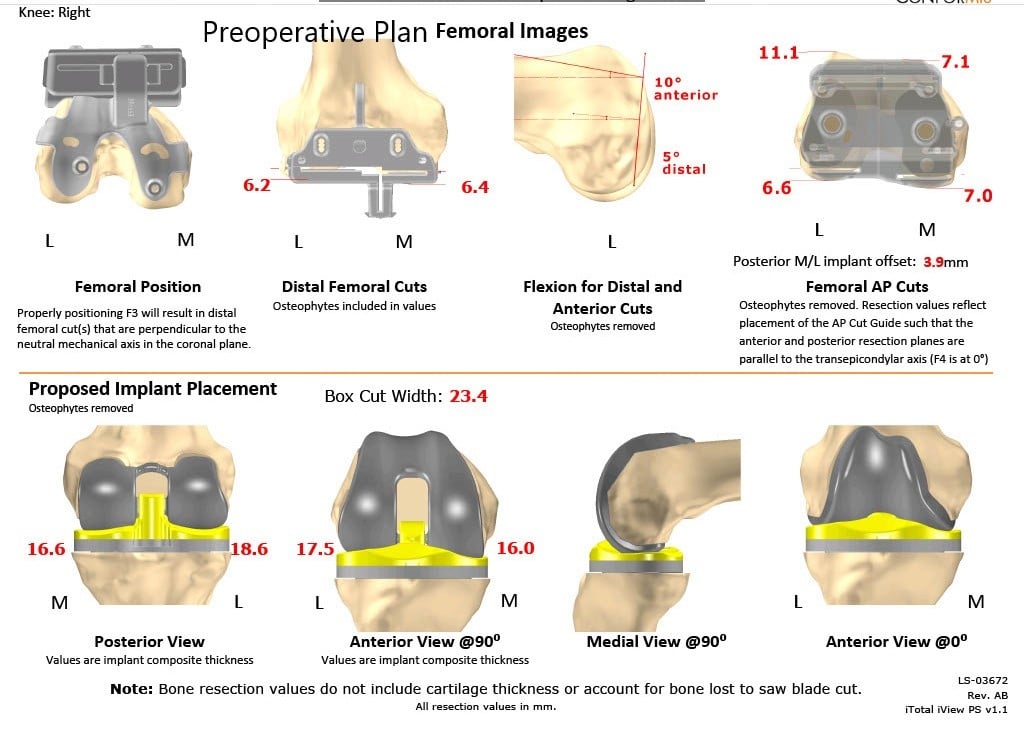 Complete Orthopedics patient specific surgical plan for a Right Custom Total Knee Replacement in a 68-year-old female - scan 2