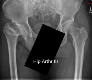 Radiografía preoperatoria que muestra la vista AP de la pelvis con ambas articulaciones de la cadera