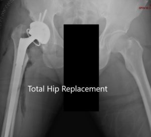 Radiografía postoperatoria que muestra la vista AP de la pelvis