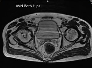 Axial section T2WI showing bilateral AVN of the femoral heads