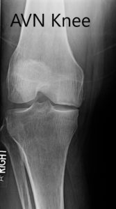 Radiografía preoperatoria de la rodilla derecha en vistas anteroposterior y lateral