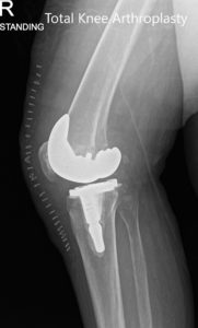 Radiografía postoperatoria que muestra las vistas anteroposterior y lateral de la rodilla derecha - img 2